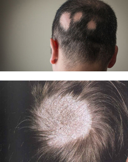 Hair Loss treatment in Mohali | Skin Clinic in Mohali | Best Skin Clinic in  Mohali | Skin care clinic in Mohali | Bes Skin care clinic in Mohali