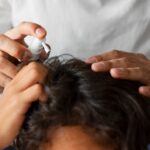 Dandruff: Causes, Symptoms and Treatment